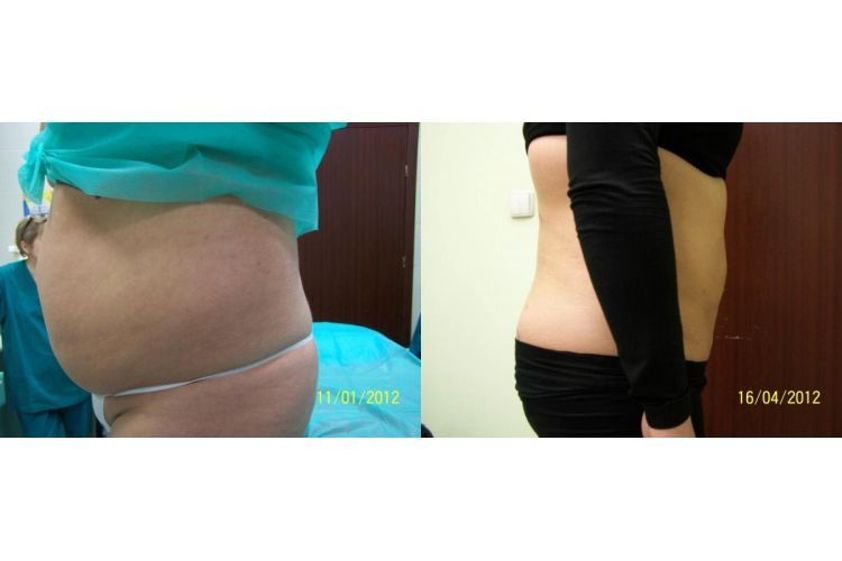 Liposukcja ultradźwiękowa przed i po - 686185