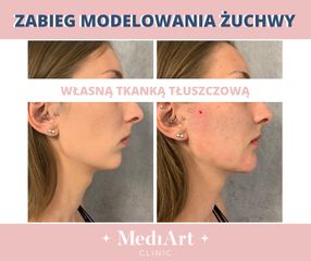 Lifting twarzy - MediArt Clinic