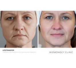 Lipotransfer / Przywracanie objętości skóry