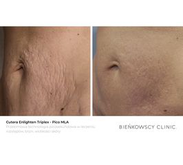 Terapia rozstępów / Cutera® Enlighten Triplex - Pico MLA