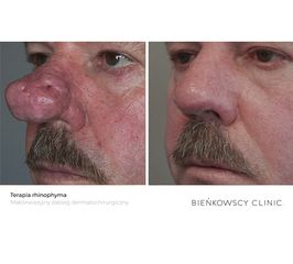 Terapia rhinophyma / Małoinwazyjny zabieg dermatochirurgiczny
