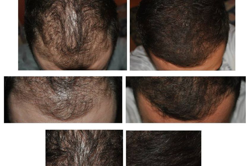 Mezoterapia igłowa przed i po - 698460