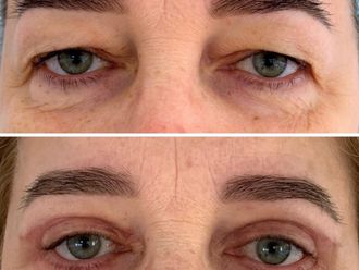 Blefaroplastyka przed i po - 868330