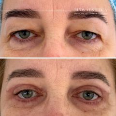 Blefaroplastyka - Dr. n. med. Sylwia Krzykawska-Figura