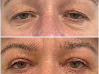 Blefaroplastyka przed i po - 872155