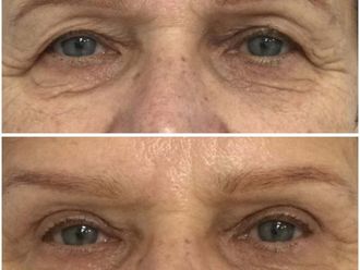 Blefaroplastyka przed i po - 872157