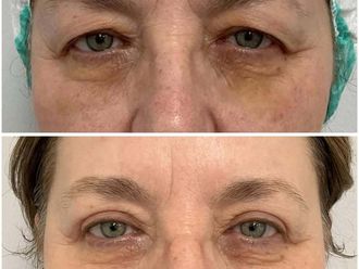 Blefaroplastyka przed i po - 876373