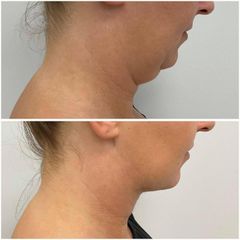Liposukcja radiofrekwencyjna - Centrum Medyczne VENO-MED Jendrysik, Kiełek