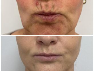 Nici liftingujące przed i po - 877091