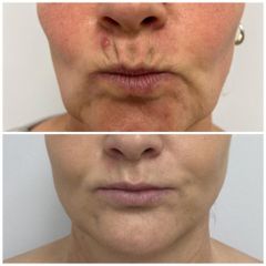 Wygładzenie drobnych zmarszczek wokół ust