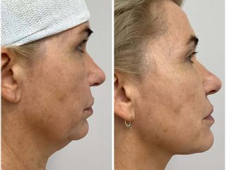 Nici liftingujące przed i po - 878479