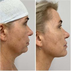 Radiofrekwencja igłowa plus nici liftingujące