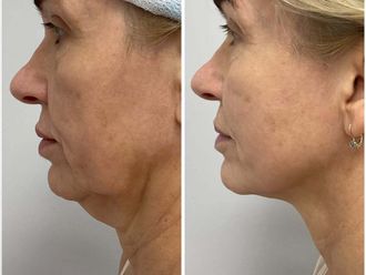 Radiofrekwencja mikroigłowa przed i po - 878480