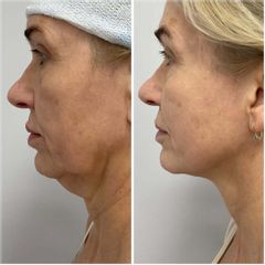 Radiofrekwencja igłowa plus nici liftingujące