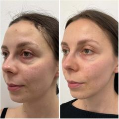 LIPOTRANSFER - Centrum Medyczne VENO-MED Jendrysik, Kiełek