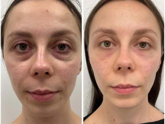 Lipofilling przed i po - 878603