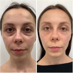 LIPOTRANSFER - Centrum Medyczne VENO-MED Jendrysik, Kiełek