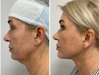 Lifting podbródka przed i po - 878647