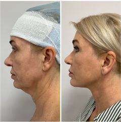 Centrum Medyczne VENO-MED Jendrysik, Kiełek Lifting podbródka