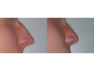 Korekta nosa: przed i po 