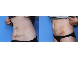 Abdominoplastyka - przed i po