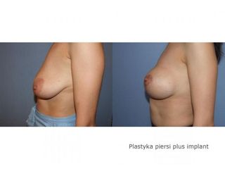 Mastopeksja z użyciem implantów - przed i po