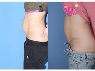 Abdominoplastyka - przed i po