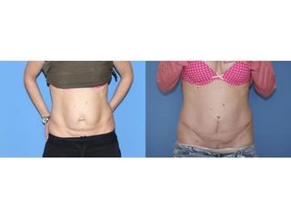 Abdominoplastyka - przed i po