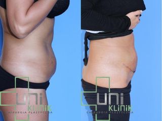 Abdominoplastyka - przed i po