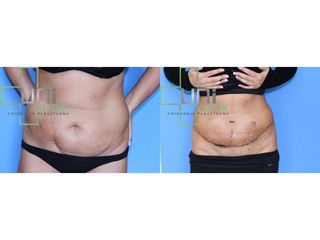 Abdominoplastyka - przed i po