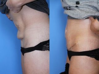 Abdominoplastyka - przed i po