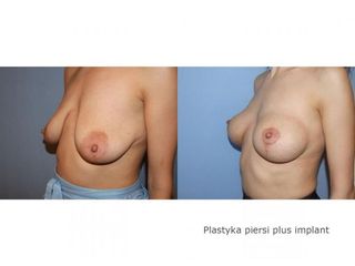 Mastopeksja z użyciem implantów - przed i po