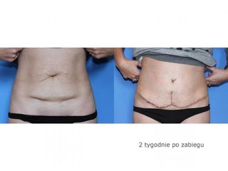Abdominoplastyka - przed i po