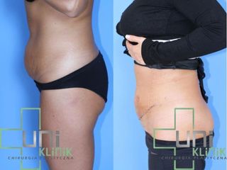 Abdominoplastyka - przed i po