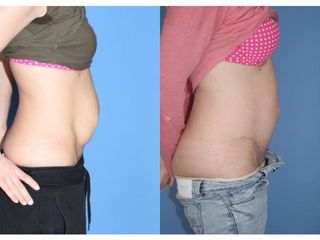 Abdominoplastyka - przed i po