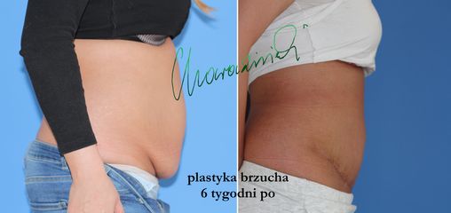 Plastyka brzucha - dr Maciej Charaziński