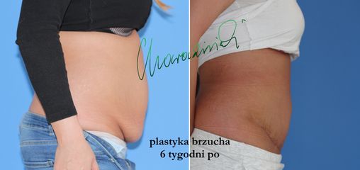 Plastyka brzucha - dr Maciej Charaziński
