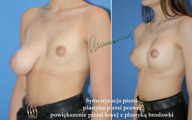 Powiększanie biustu - dr Maciej Charaziński