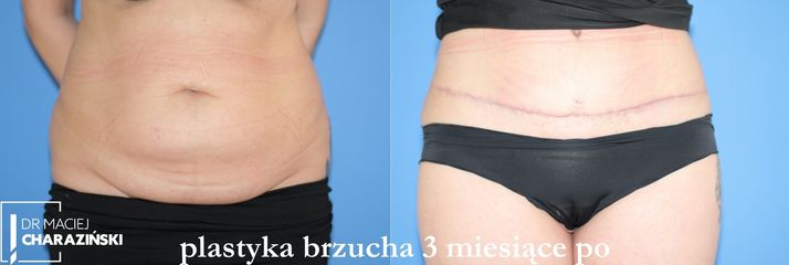 Plastyka brzucha - dr Maciej Charaziński