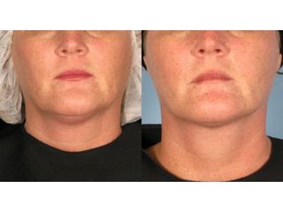 Liposukcja podbródka - przed i po