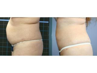 Liposukcja laserowa - przed i po