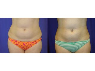 Liposukcja (odsysanie tłuszczu) - przed i po