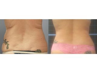 Liposukcja (odsysanie tłuszczu) - przed i po