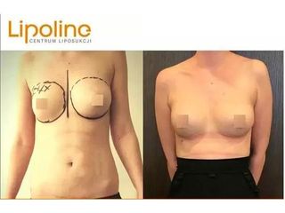Lipotransfer do piersi - przed i po