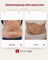 Abdominoplastyka KCM