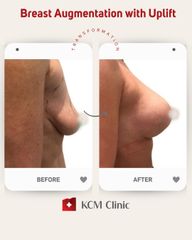 Powiększanie biustu - KCM Clinic Chirurgia Plastyczna i Bariatria