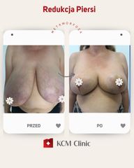 Zmniejszenie biustu - KCM Clinic Chirurgia Plastyczna i Bariatria