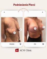 Powiększanie biustu - KCM Clinic Chirurgia Plastyczna i Bariatria