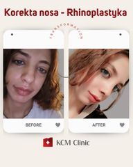 Korekta nosa - KCM Clinic Chirurgia Plastyczna i Bariatria
