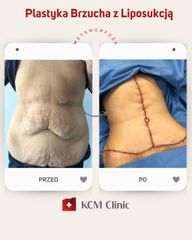 Plastyka brzucha - KCM Clinic Chirurgia Plastyczna i Bariatria